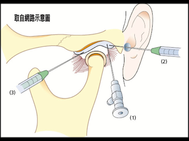 長期頭痛,聽到關節內的彈響聲甚至耳鳴?小心顳顎關節出問題了!