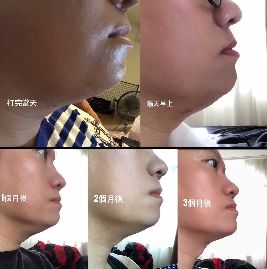各牌消脂針使用分析:作用機轉、成效、術後修復與後遺症?