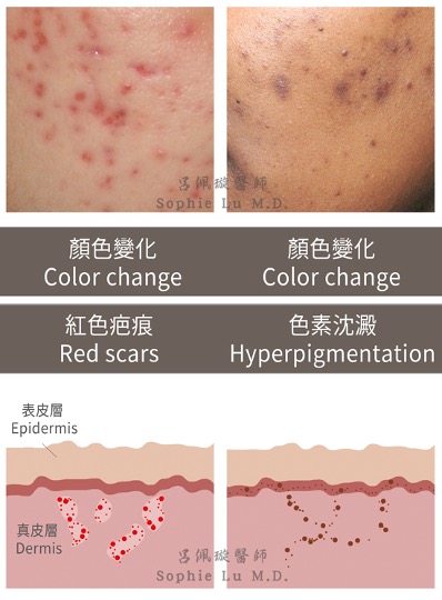 戰鬥!痘疤手術有哪些武器可以用?