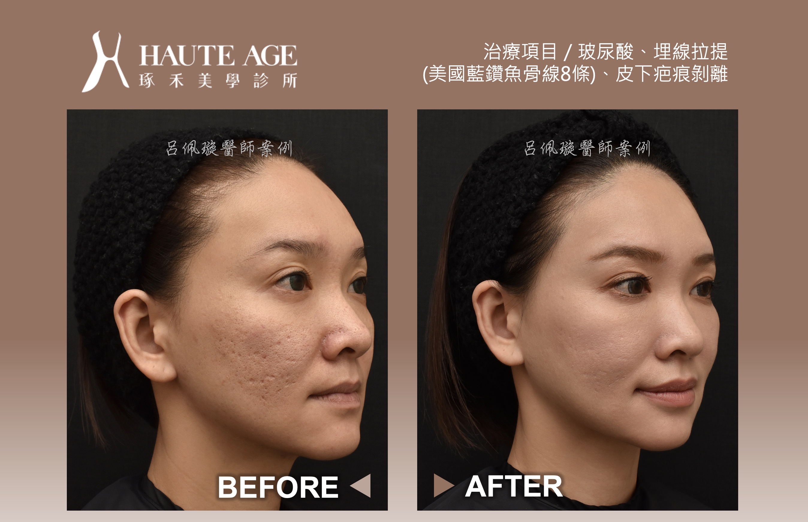 臉部拉提與皮膚緊實，可以等同於拉皮手術的效果嗎？