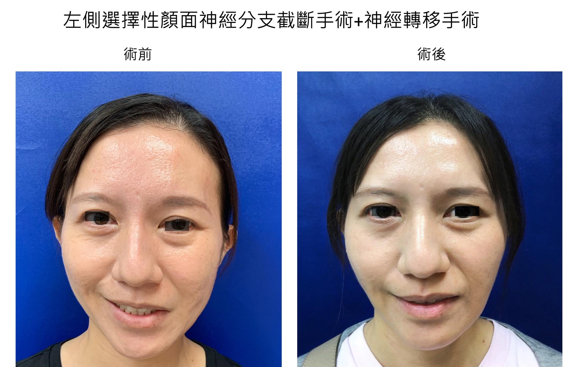 什麼是顏面神經麻痺後顫抖?顫抖怎麼治?